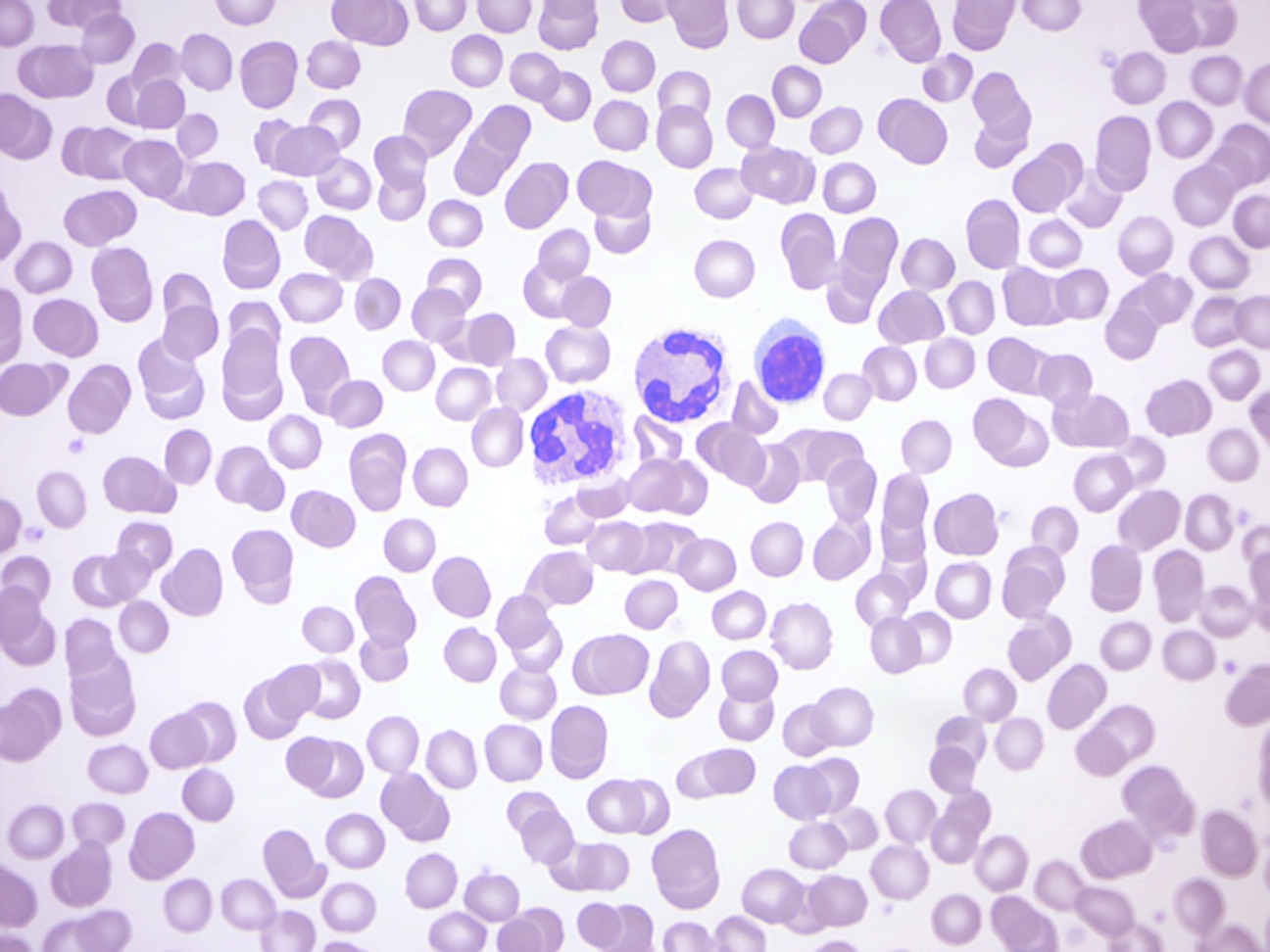 Human blood smear. Note red and two types of white blood cells.
