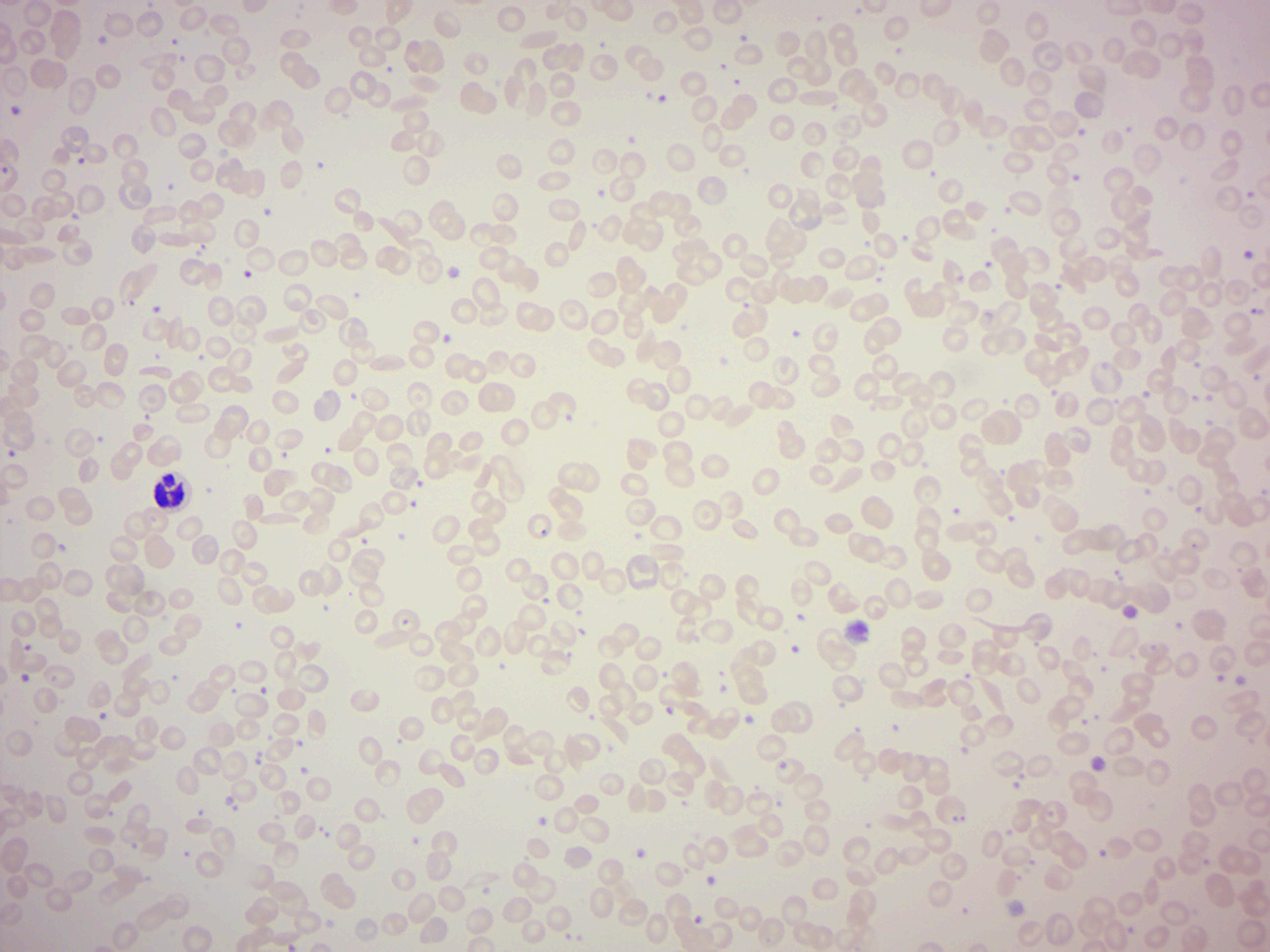 Sickle cell blood smear.