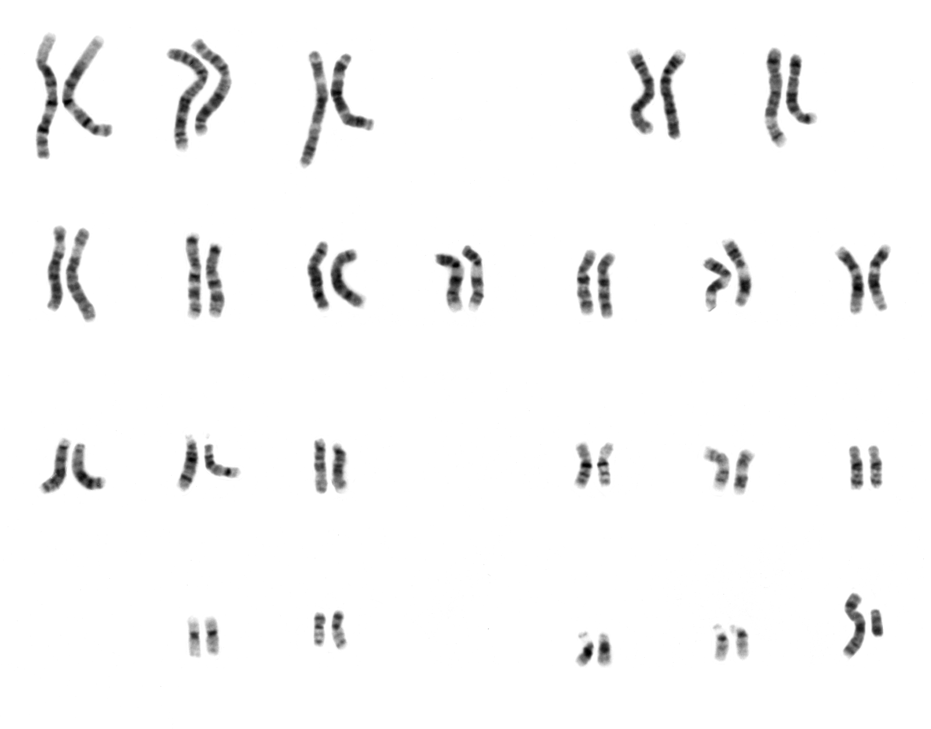 The karyotype of a normal human male consisting of 22 pairs of autosomes and 2 sex chromosomes (one x and one y chromosome). The karyotype is the characteristic chromosome complement of a eukaryote species.