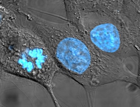 HeLa cells stained for nuclear DNA with the blue fluorescent Hoechst dye. The central and rightmost cell are in interphase, thus their entire nuclei are labeled. On the left, a cell is going through mitosis and its DNA has condensed. HeLa is an immortal cell line used in scientific research. It is the oldest and most commonly used human cell line. The line is derived from cervical cancer cells taken on February 8, 1951, from Henrietta Lacks, a 31-year-old African-American mother of five, who died of cancer on October 4, 1951. The cell line was found to be remarkably durable and prolific, which allows it to be used extensively in scientific study. The cells from Lacks’ cancerous cervical tumor were taken without her knowledge or consent, which was common practice at the time. Cell biologist George Otto Gey found that they could be kept alive, and developed a cell line. Previously, cells cultured from other human cells would only survive for a few days. Cells from Lacks’ tumor behaved differently. As was custom for Gey’s lab assistant, she labeled the culture ‘HeLa’, the first two letters of the patient’s first and last name; this became the name of the cell line. HeLa was the subject of a 2010 book by Rebecca Skloot, The Immortal Life of Henrietta Lacks, investigating the historical context of the cell line and how the Lacks family was involved its use.