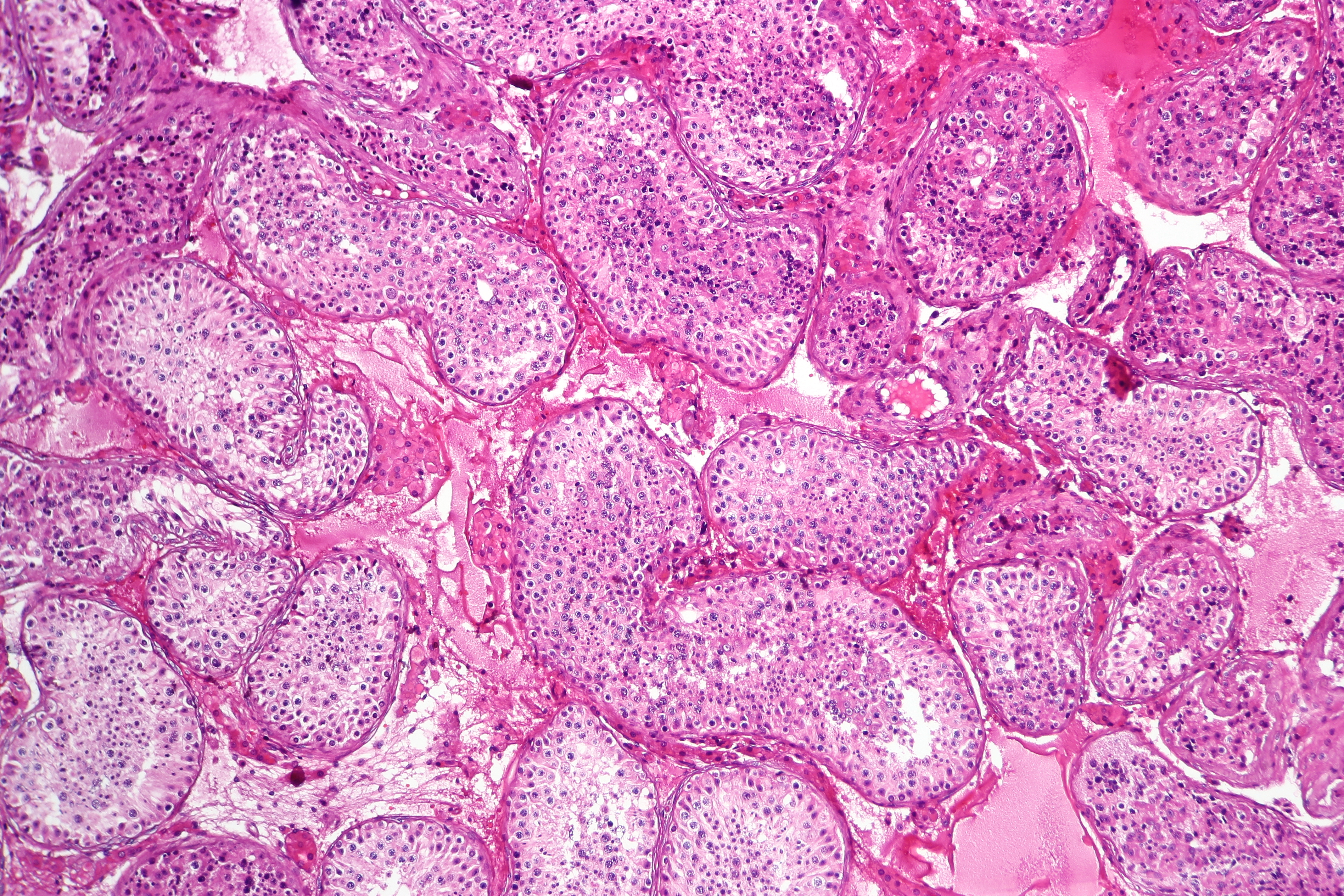 Normal spermatogenesis, testis biopsy.