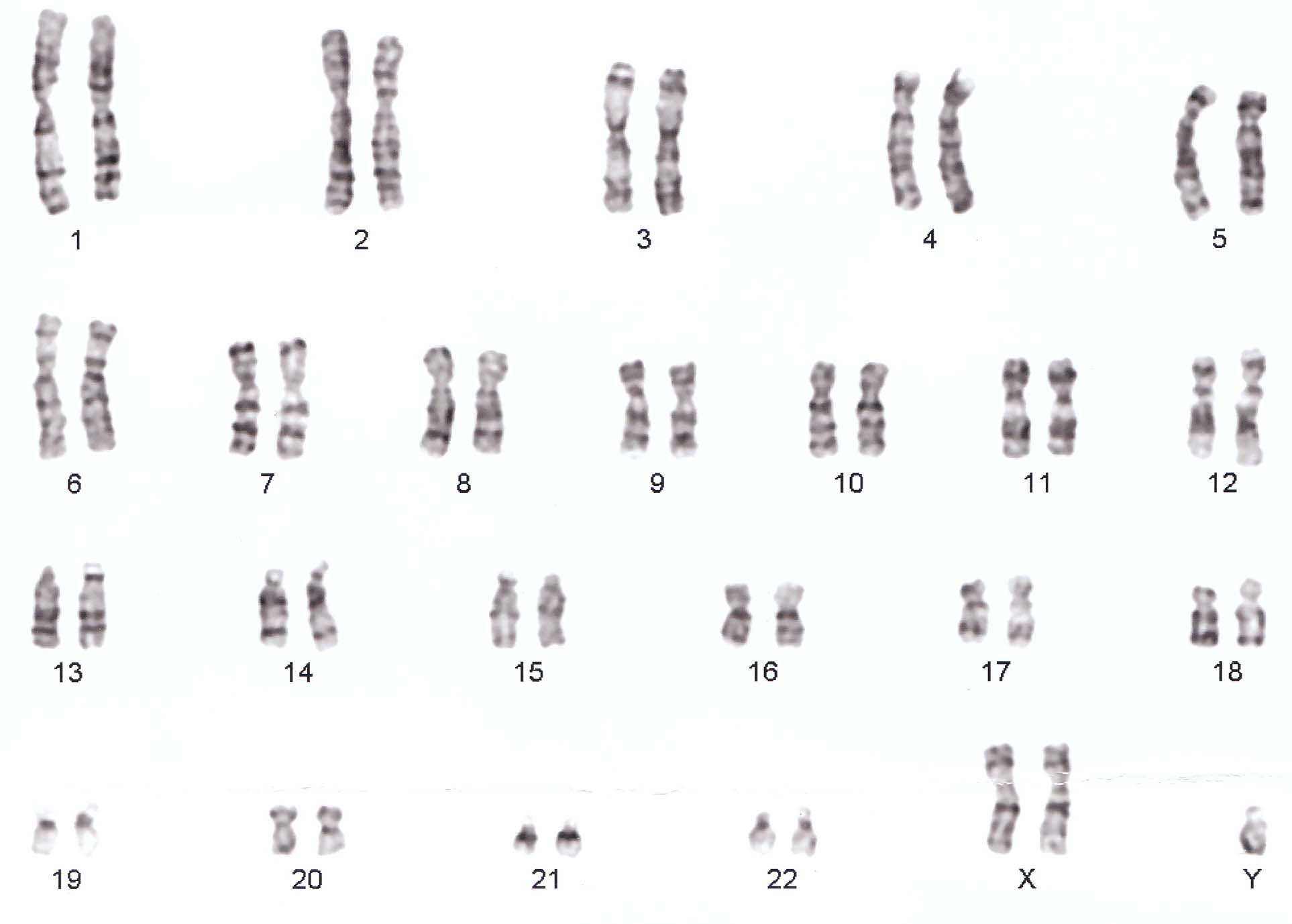 Klinefelter syndrome karyotype (XXY)