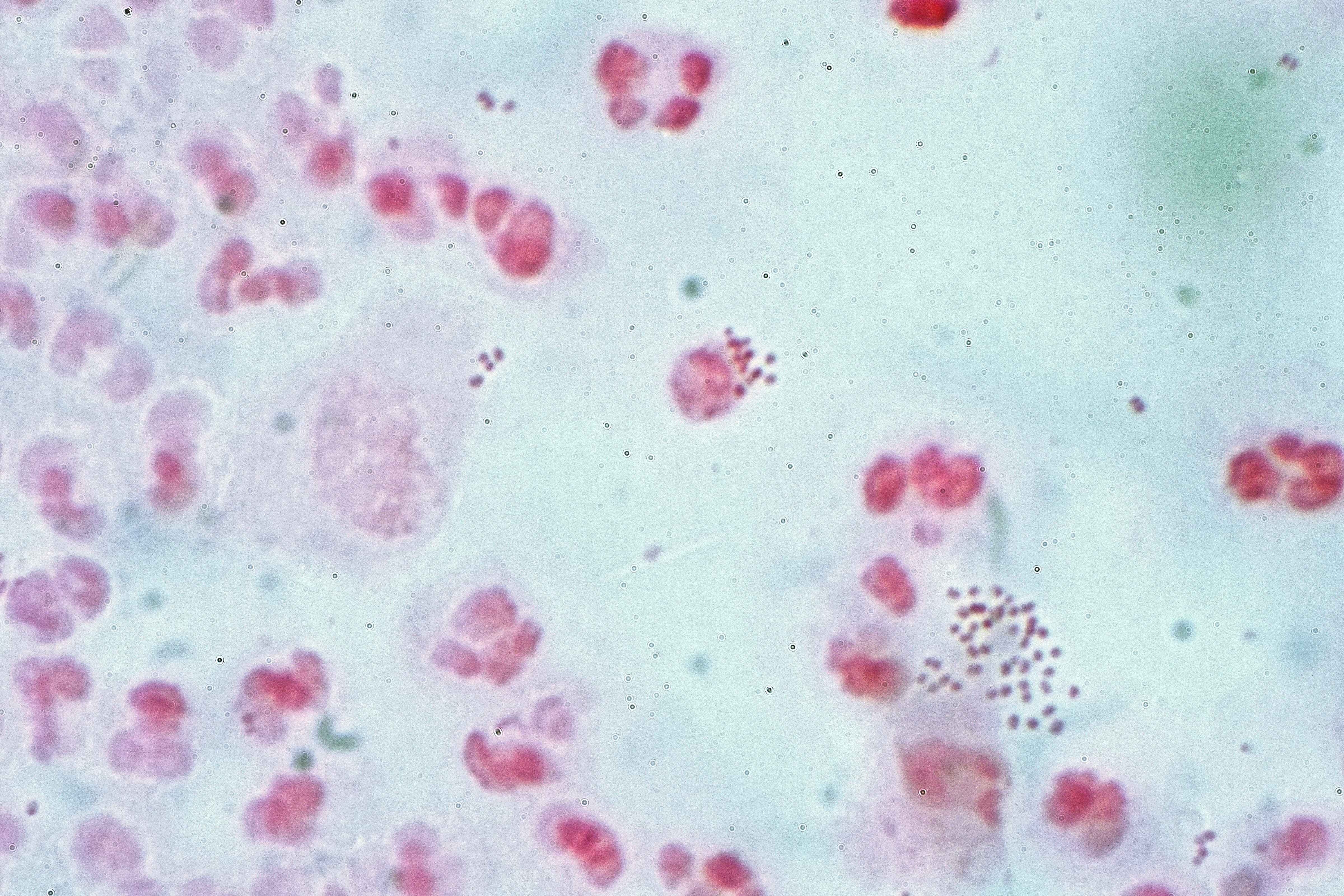 Neisseria gonorrhoea in pus from a man with a purulent urethral discharge - Gram stain.