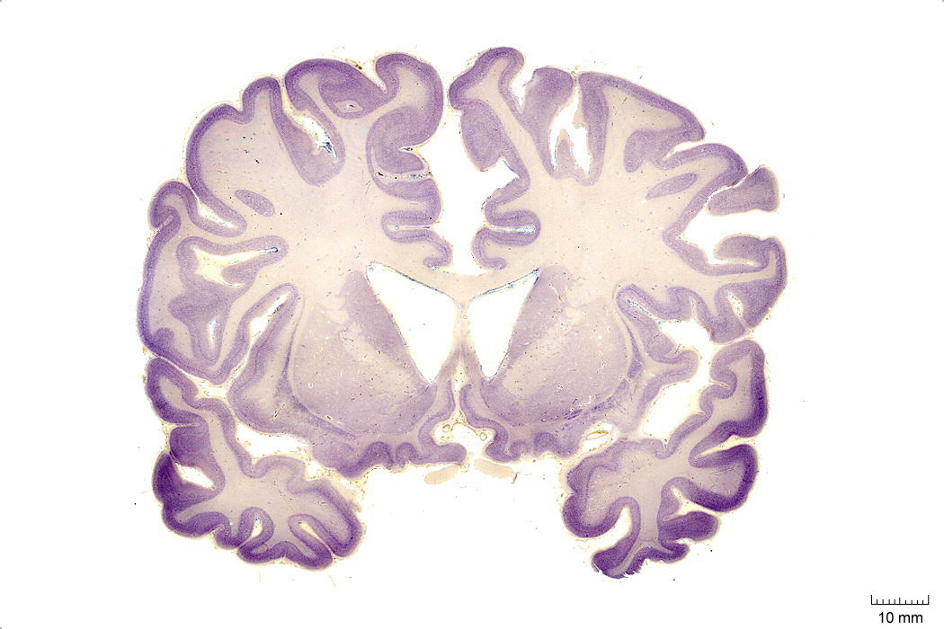 Coronal section from The Human Brain Atlas at the Michigan State University Brain Biodiveristy Bank which acknowledges their support from the National Science Foundation.