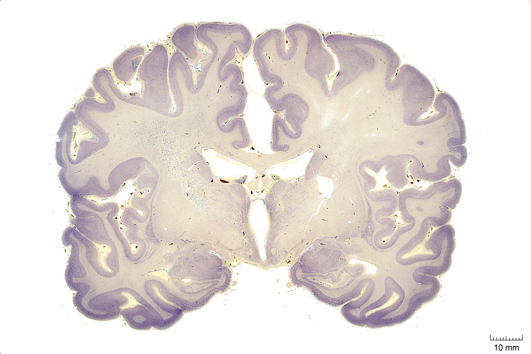 Coronal section from The Human Brain Atlas at the Michigan State University Brain Biodiveristy Bank which acknowledges their support from the National Science Foundation.