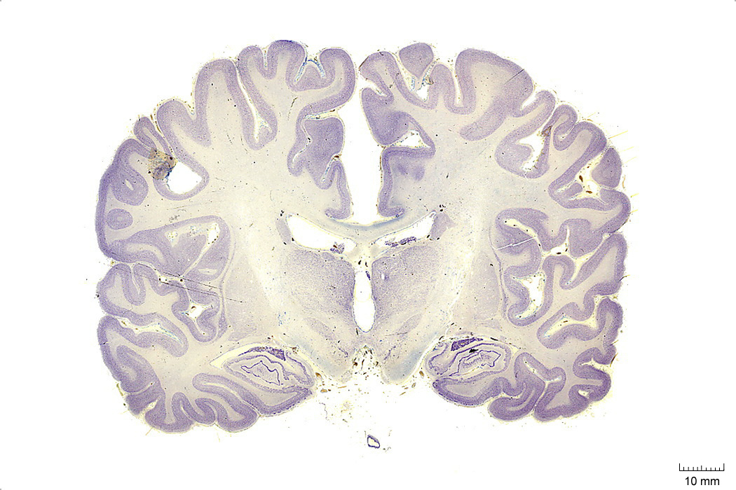 Coronal section from The Human Brain Atlas at the Michigan State University Brain Biodiveristy Bank which acknowledges their support from the National Science Foundation.