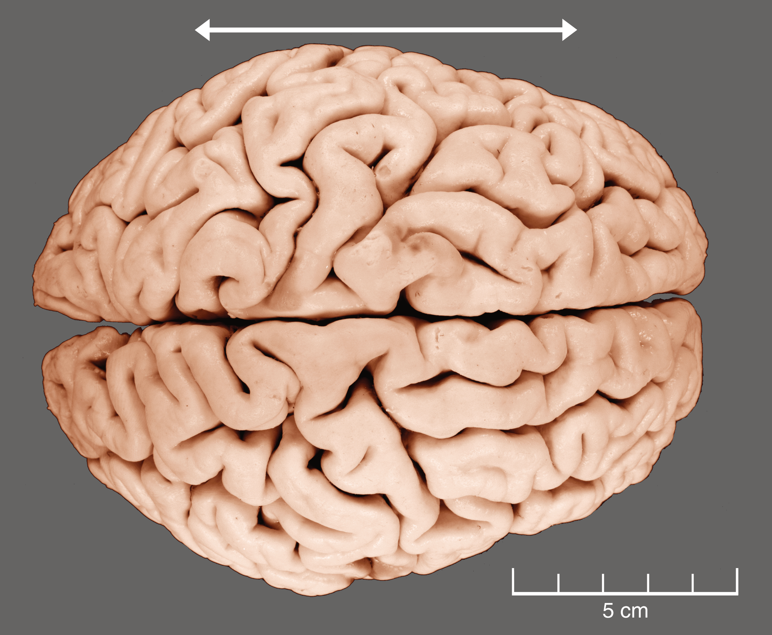 A dorsal view of a human brain.