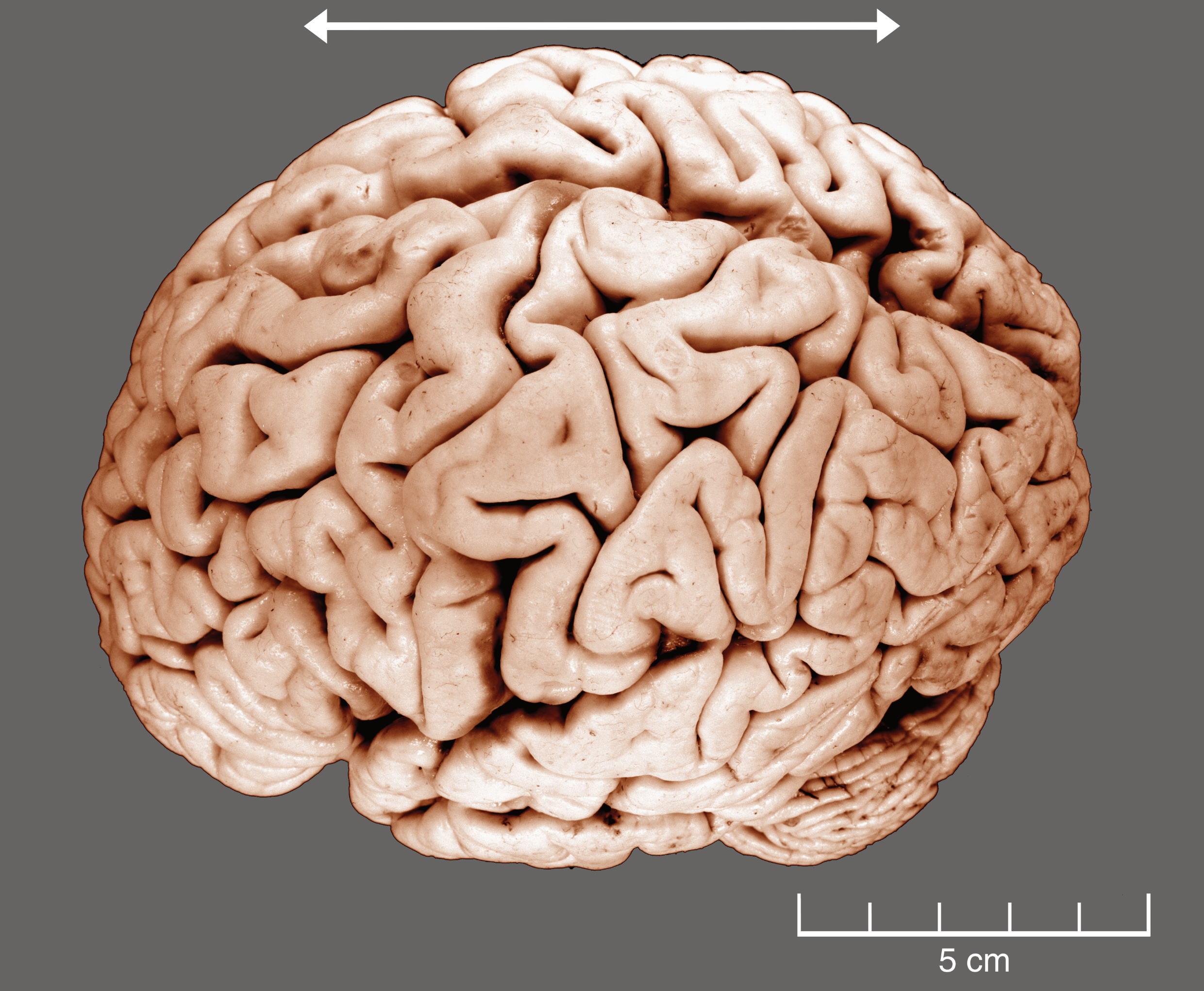 A dorso-lateral view of a human brain.