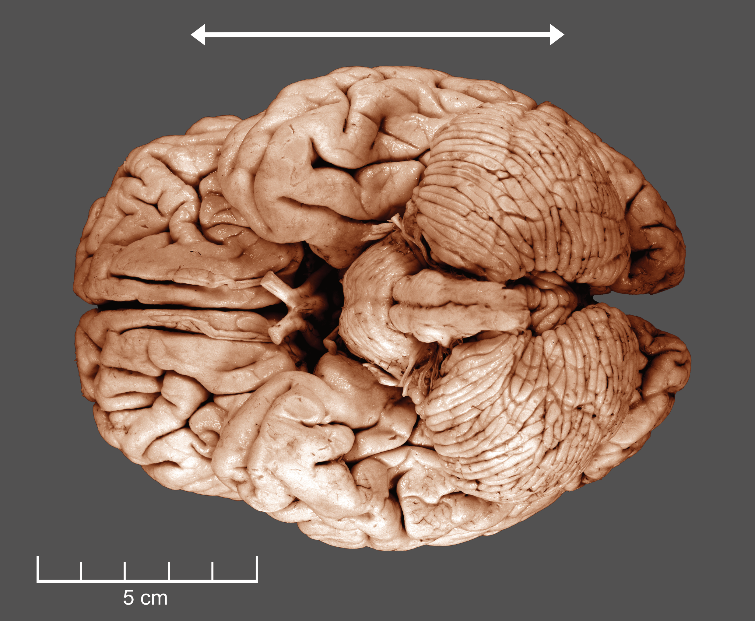 A ventral view of a human brain.