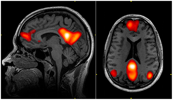 The default mode network (DMN) includes regions in the medial pre-frontal cortex, precuneus, and bilateral parietal cortex. Highlighted regions in the images were all correlated with the same component from an independent component analysis of an individual’s resting state fMRI data. The color scale reflects correlation z-scores, with a lower threshold of z = 3. From Graner John, Oakes Terrence, French Louis, Riedy: Functional MRI in the Investigation of Blast-Related Traumatic Brain Injury. Frontiers in Neurology, vol. 4, 2013