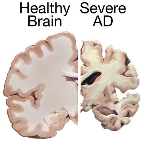 Comparison of brain tissue between healthy individual and Alzheimer’s disease patient, demonstrating extent of neuronal death