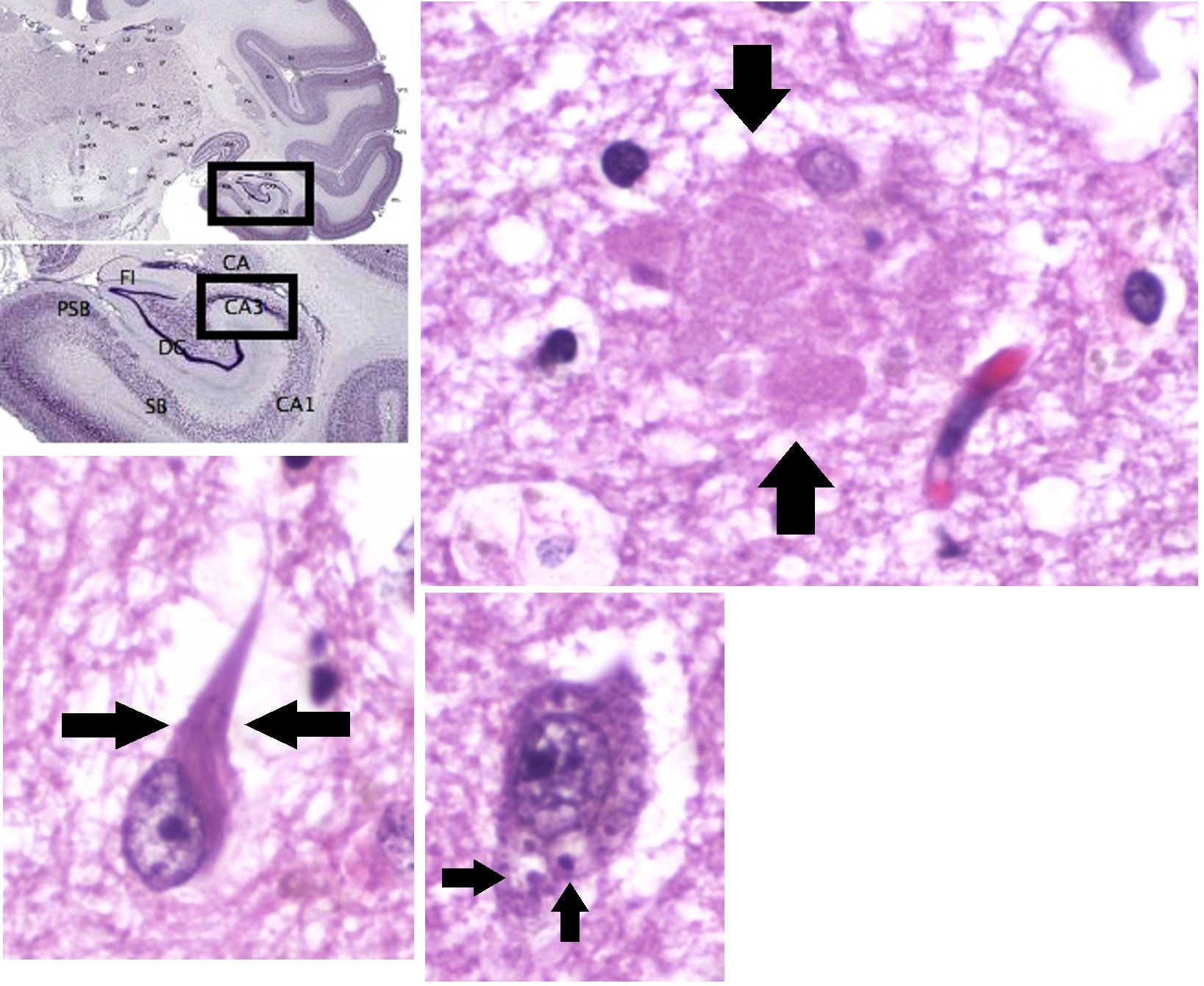 Histopathologic images of Alzheimer’s disease, in the CA3 area of the hippocampus, showing an amyloid plaque (top right), neurofibrillary tangles (bottom left) and granulovacuolar degeneration (bottom center).