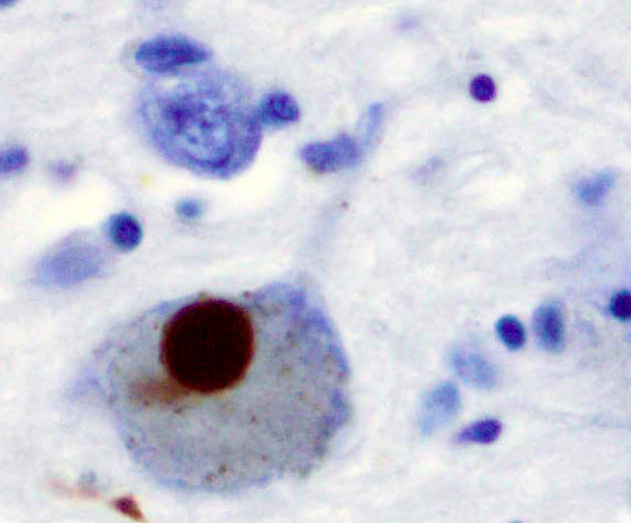 A Lewy body (stained brown) in a brain cell of the substantia nigra in Parkinson’s disease. The brown colour is positive immunohistochemistry staining for alpha-synuclein.