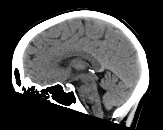 Normal brain CT scan. Case courtesy of Assoc Prof Frank Gaillard