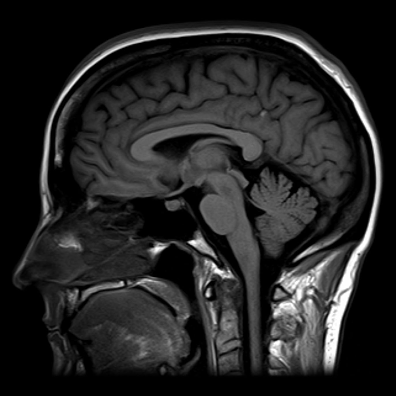 Normal MRI T1 sagittal section through the brain. Case courtesy of Assoc Prof Frank Gaillard.